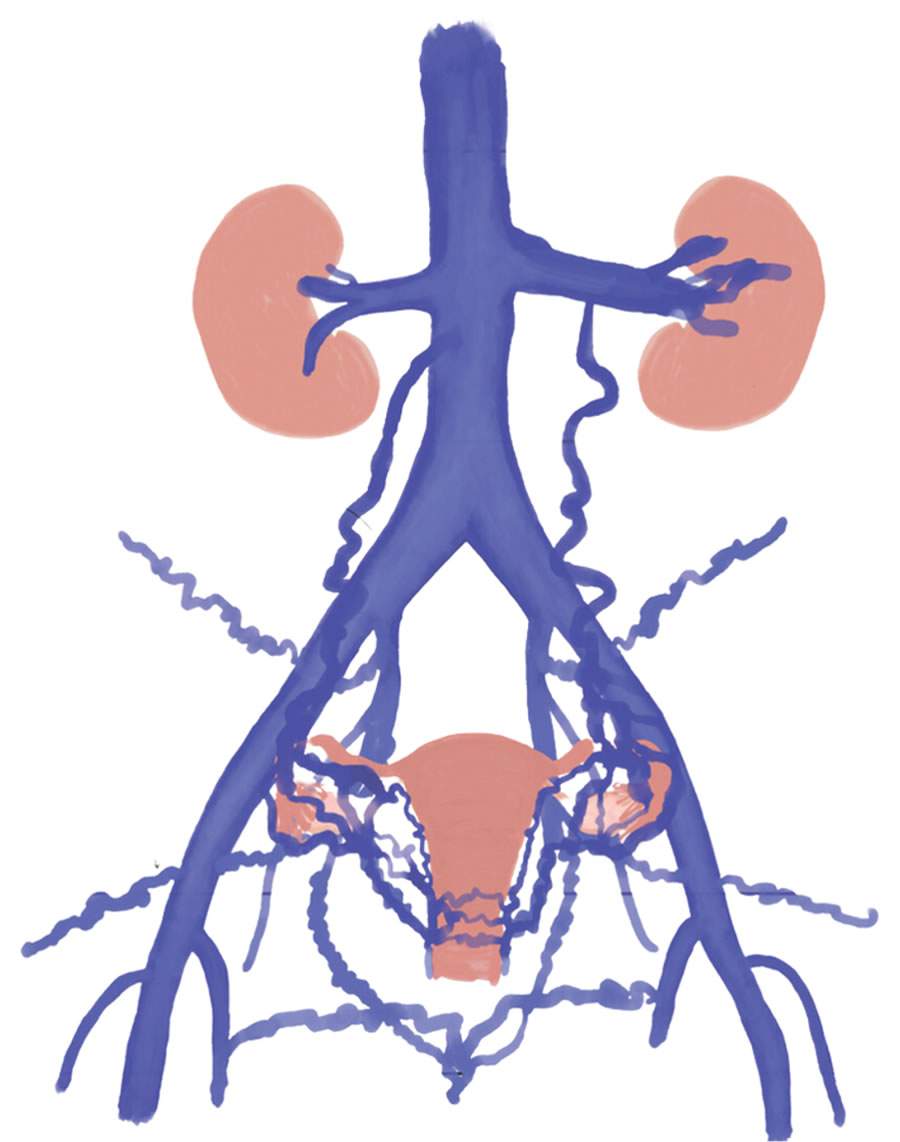 Varizes pélvicas x endometriose: como diferenciar sintomas tão parecidos?