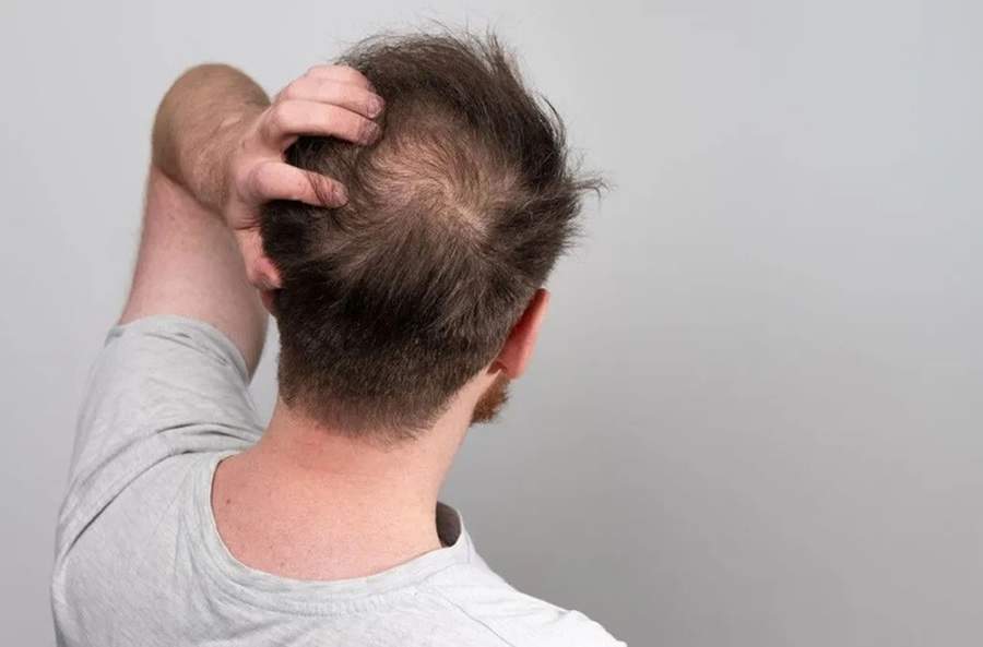 Qual é a principal causa da queda de cabelo? Descubra agora e veja como lidar com esse problema